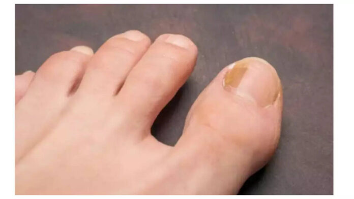 5-symptoms-of-Nail-Cancer-that-can-go-unnoticed.cms_.jpeg